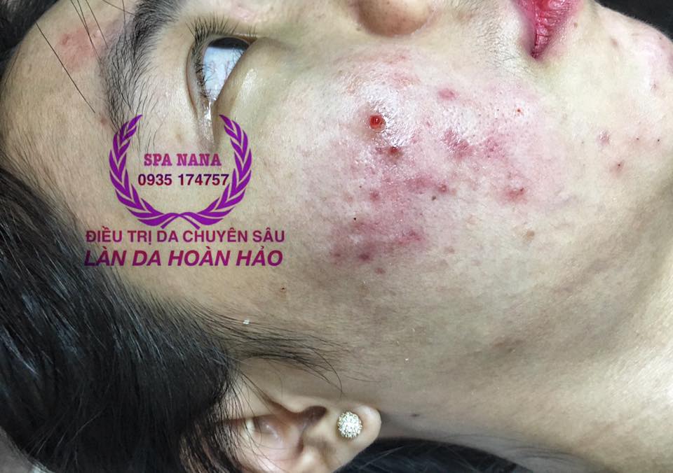 Điều trị và chăm sóc da cho 1 em gái ở Long Khánh